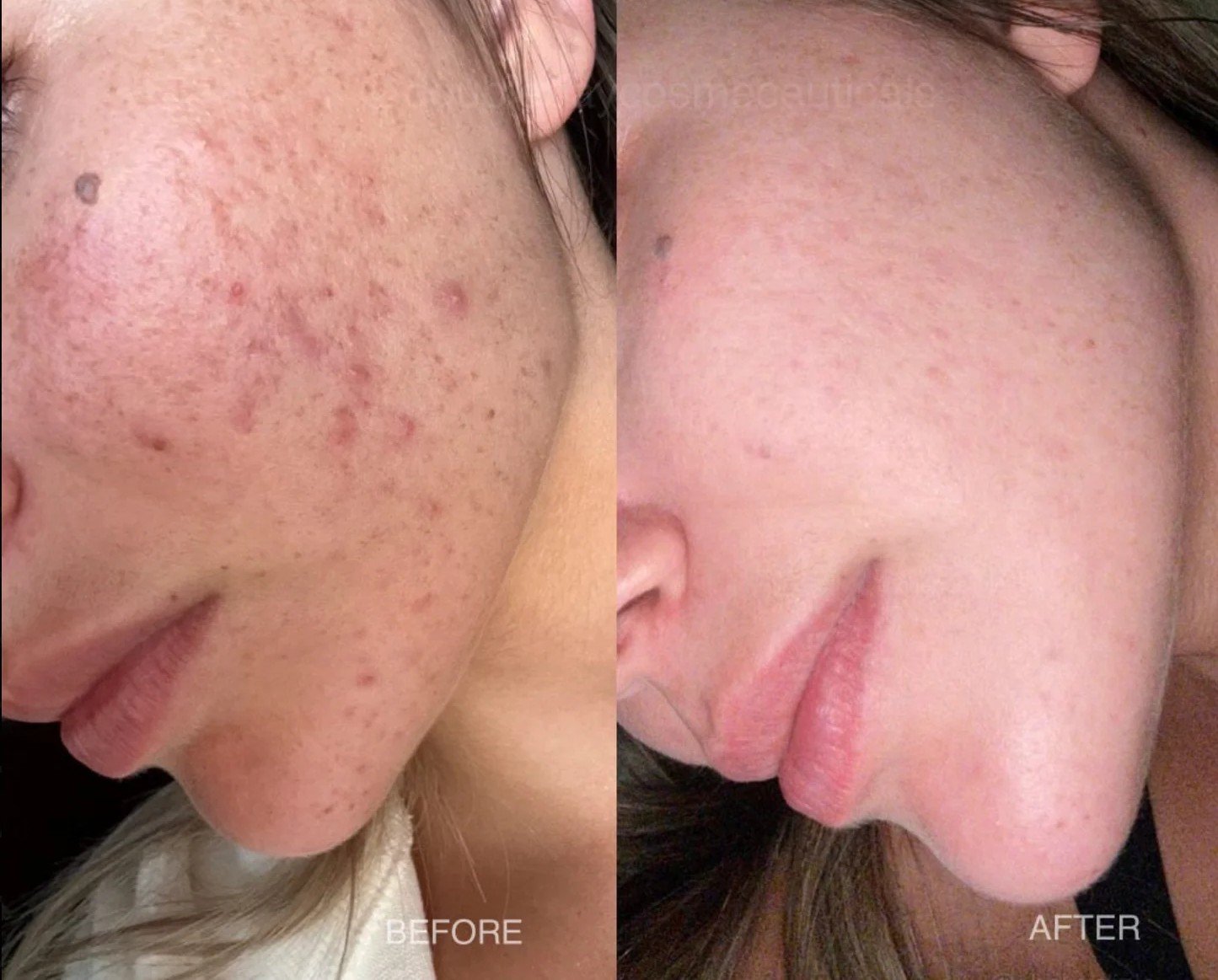 ECTOIN 7% ACNE 168H REPAIR TREATMENT - Imagen 2